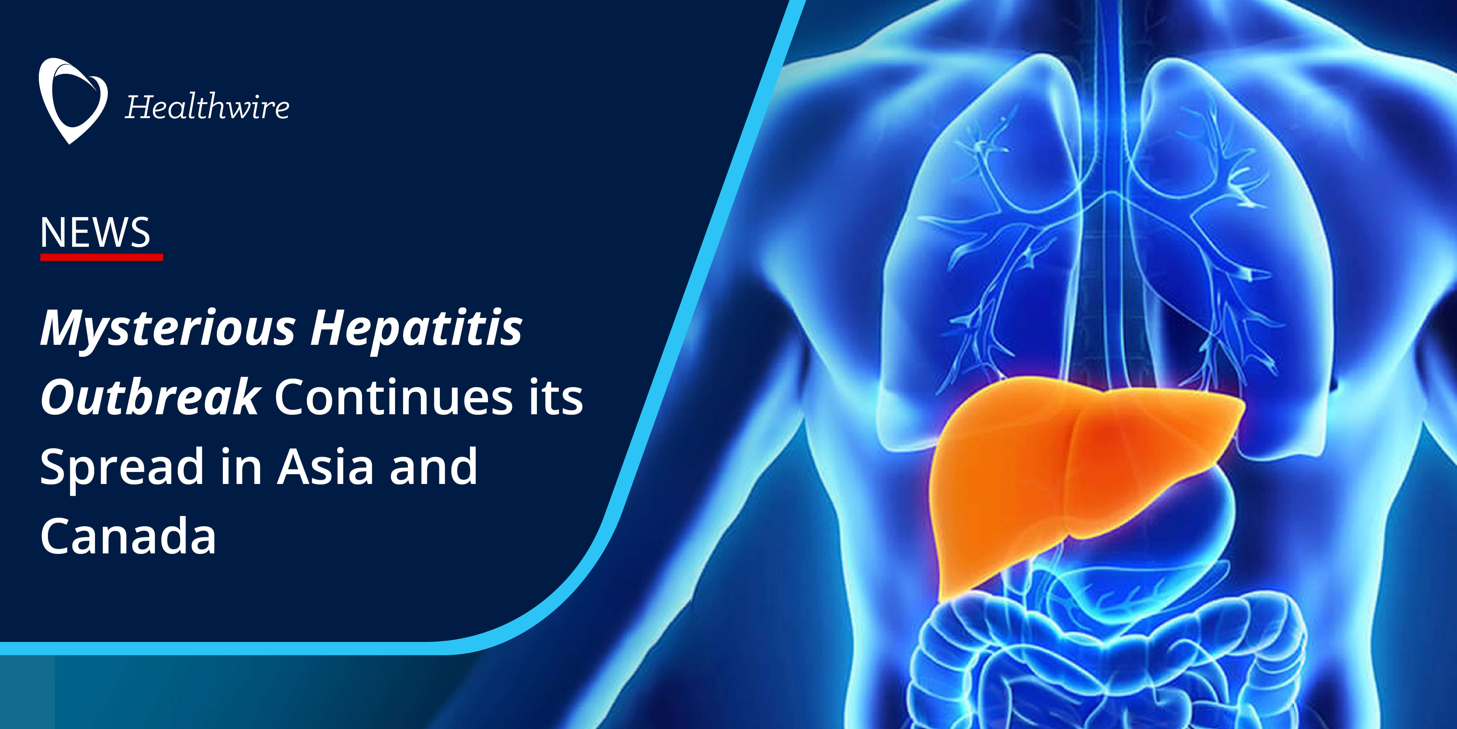Mysterious hepatitis outbreak continues its spread in asia and canada