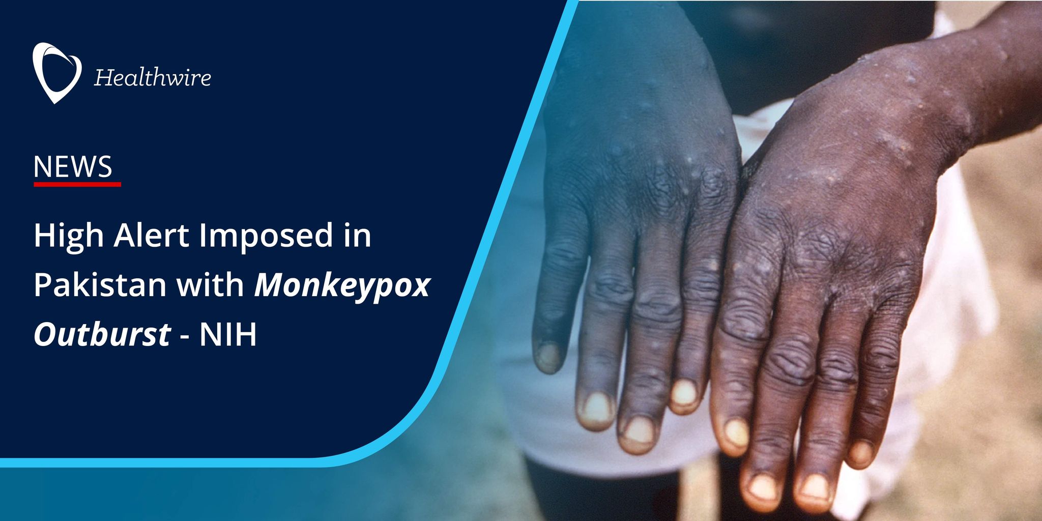 High alert imposed in pakistan with monkeypox outburst nih